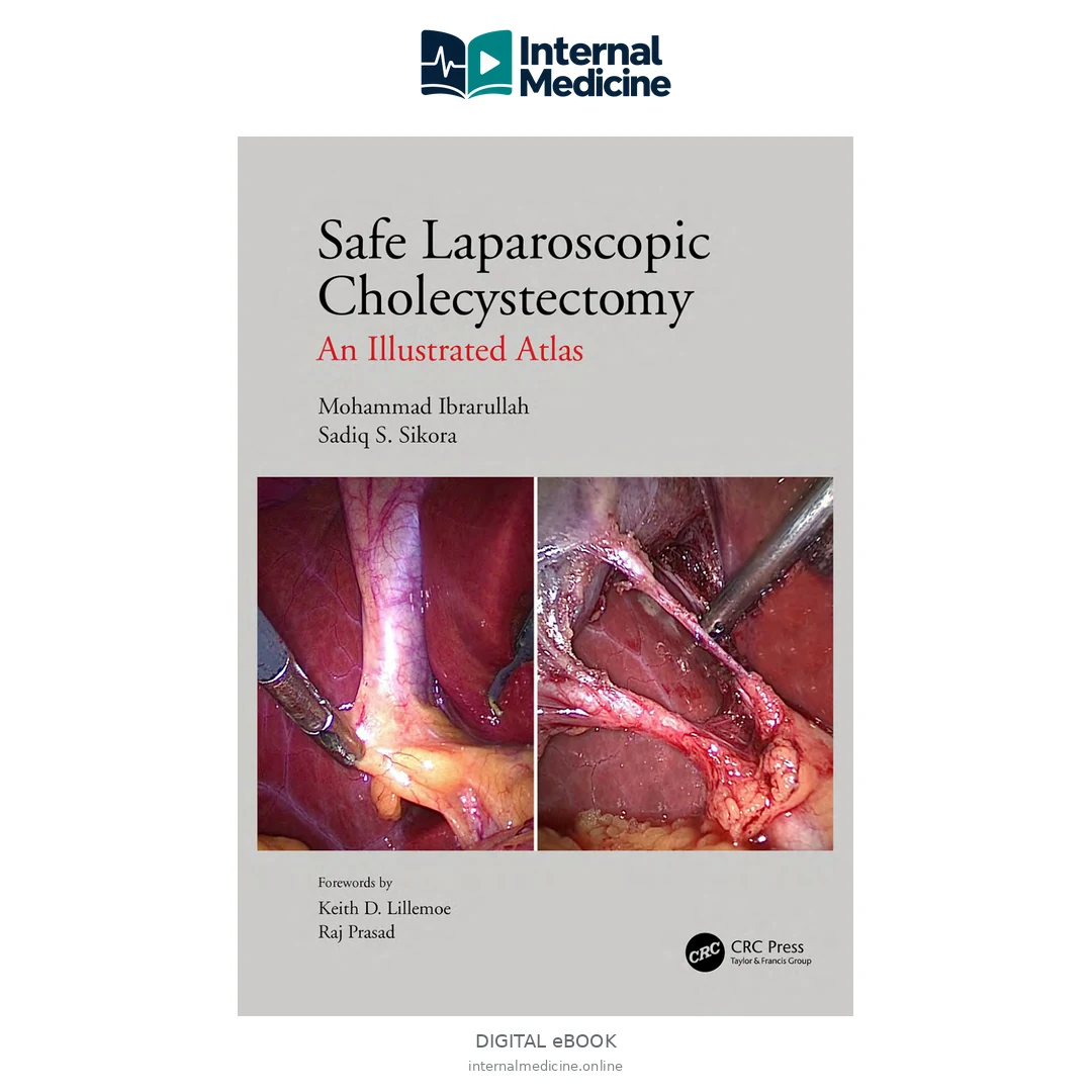Mohammad Ibrarullah, Sadiq S Sikora Safe Laparoscopic Cholecystectomy — Digital eBook